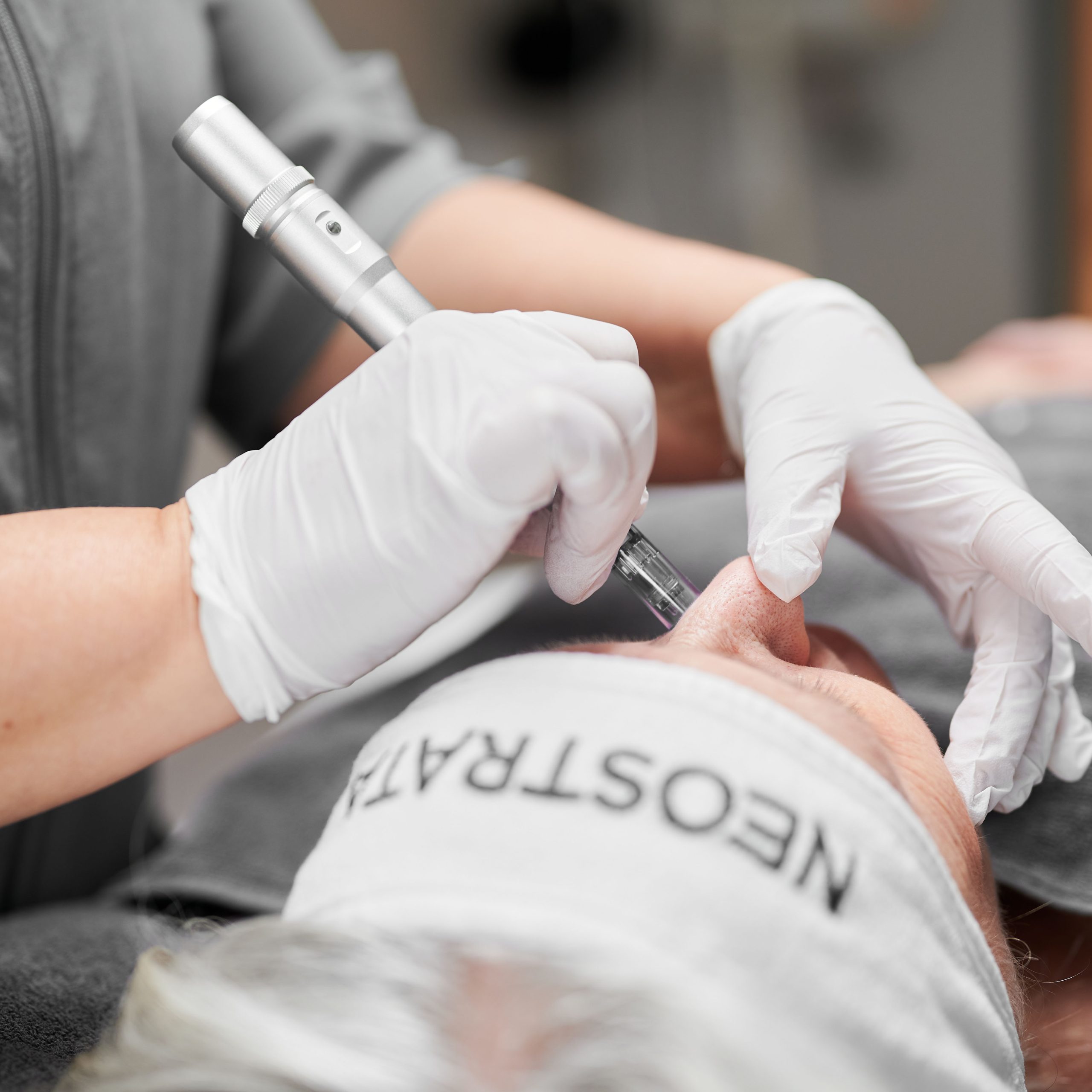 Microneedling 3 Microneedling näsa
